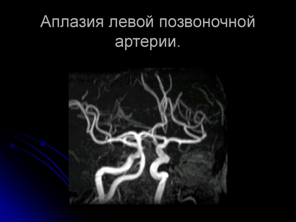 Гипоплазия правой головного мозга. Гипоплазия позвоночной артерии кт. Гипоплазия правой позвоночной артерии на кт. Гипоплазия v4 позвоночной артерии. Гипоплазия мозговой артерии.