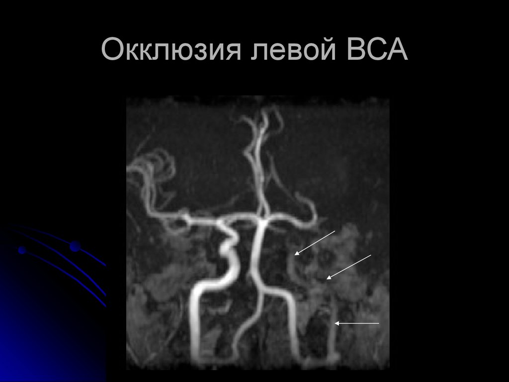 Стеноз устья вса. Окклюзия артерий головного мозга. Окклюзия позвоночной артерии мрт. Окклюзия внутренней сонной артерии.
