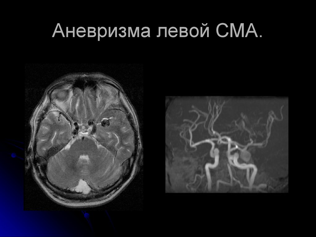 Сма мозга. Аневризма средней мозговой артерии мрт. Аневризма мозговых артерий кт. Обызвествленная аневризма средней мозговой артерии кт. Аневризма ствола головного мозга мрт.