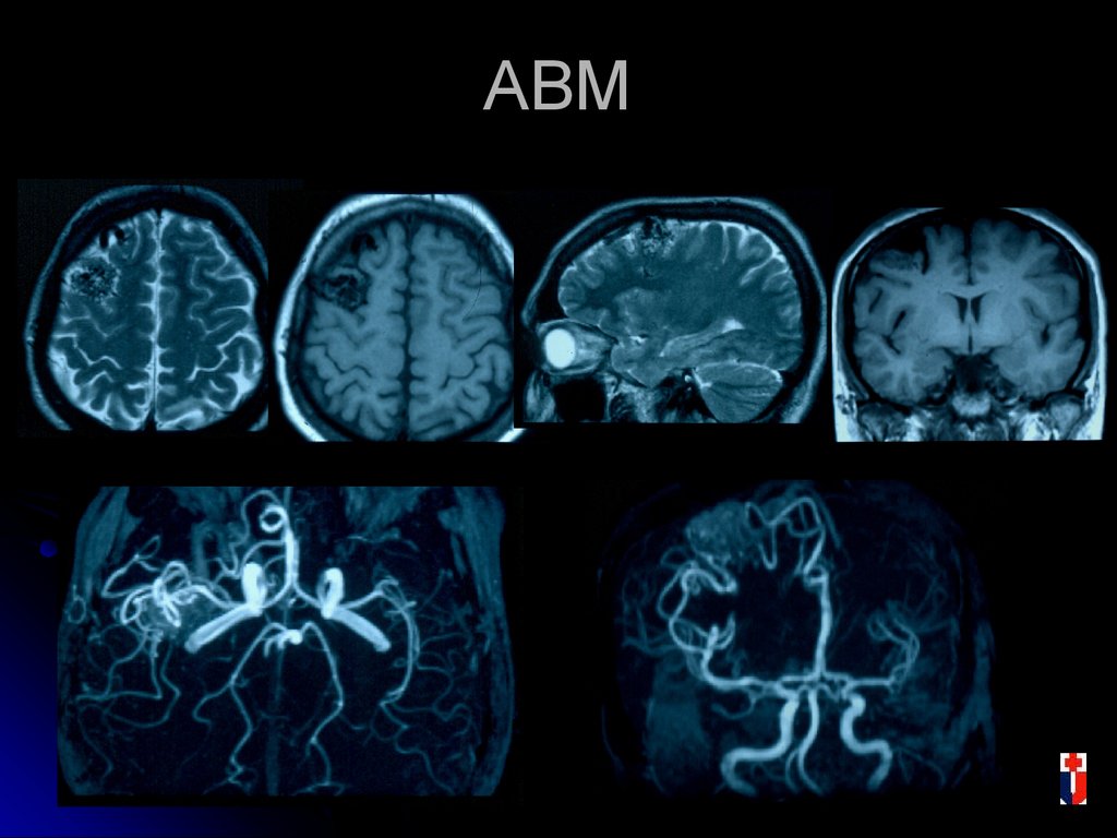 Сосудистая аномалия. АВМ мальформация сосудов головного мозга. Венозная мальформация головного мозга мрт. Мальформация сосудов головного мозга кт. Врожденная мальформация сосудов головного мозга.