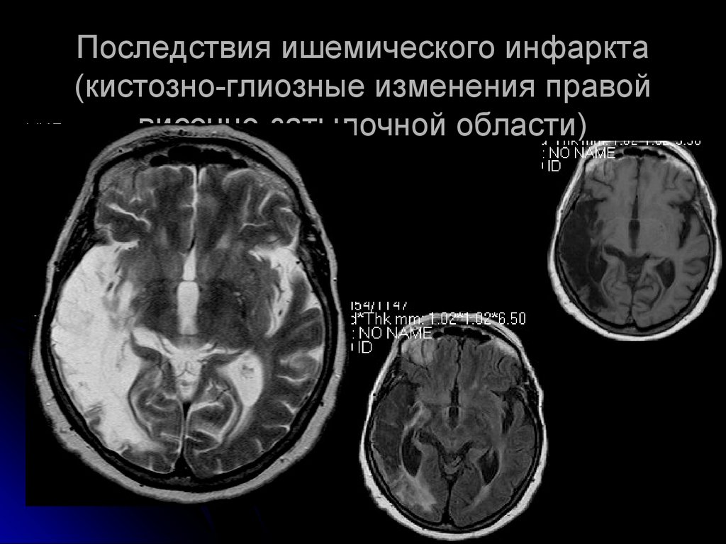 Кистозно атрофические изменения головного. Кистозно-глиозные изменения головного. Кистозно-глиозные изменения головного мозга кт. Кистозно-глиозные изменения мрт. Кистозно-атрофические изменения головного мозга на кт.