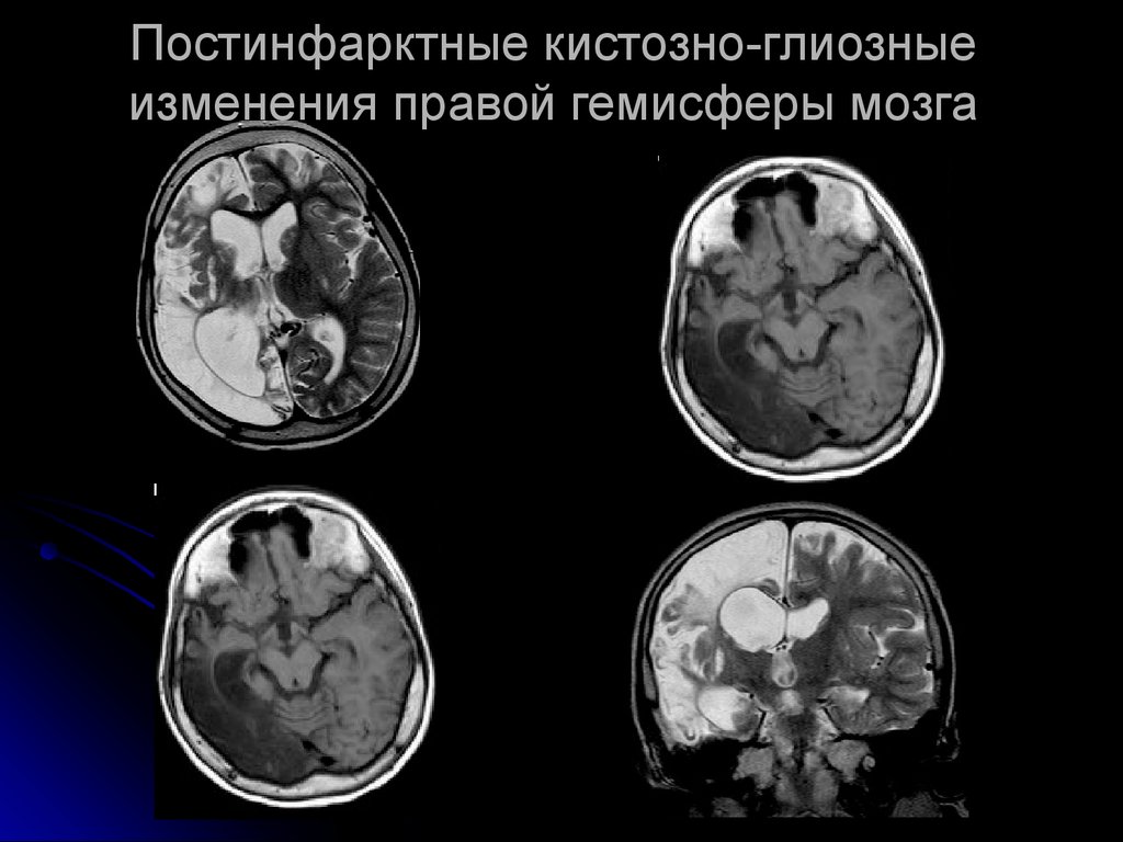 Кистозно атрофические изменения головного. Кистозно-атрофические изменения головного мозга мрт. Кистозно-глиозная трансформация головного мозга на кт. Кистозно-глиозные изменения головного. Глиозные изменения головного мозга на кт.
