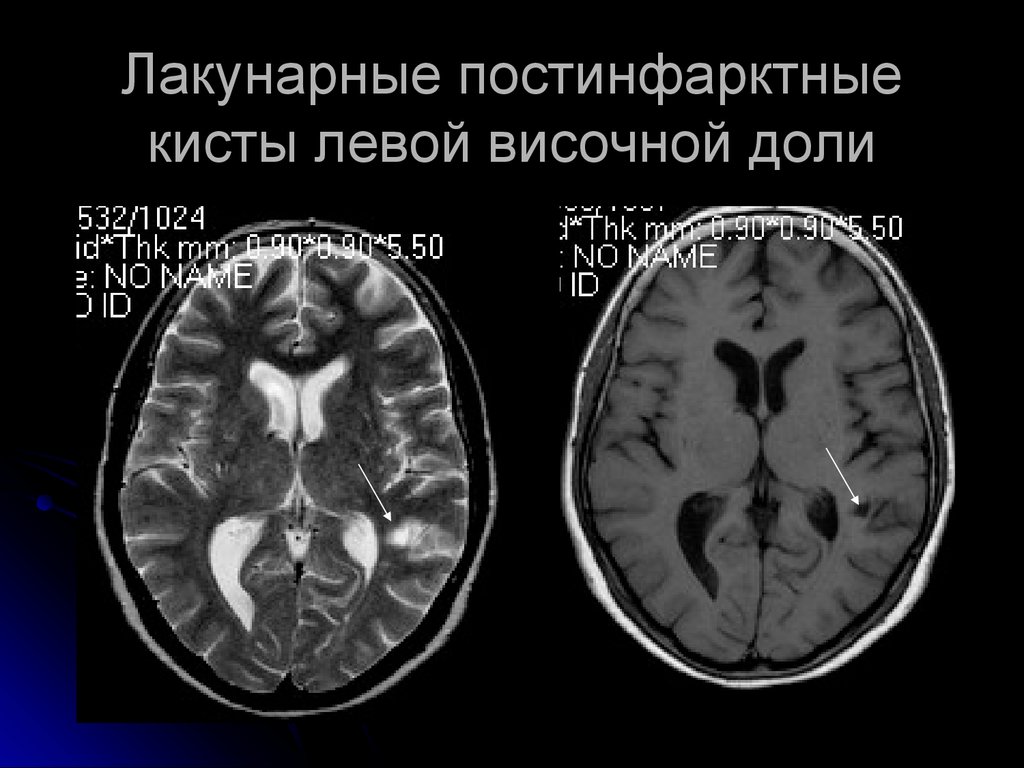 Киста в лобной доле. Киста головного мозга на кт. Киста левой височной доли. Постинфарктная киста головного мозга. Лакунарная киста головного мозга на кт.