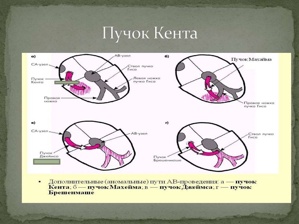 Дополнительный путь. Пучки Кента Джеймса Махайма. Пути Кента, Джеймса и Махайма. Пучок Кента волокна Махайма. Дополнительные пути проведения в сердце.