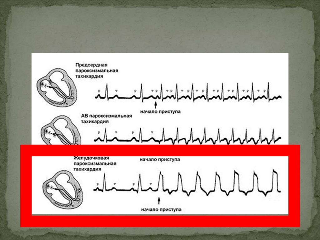 Что такое пароксизмальная тахикардия. Предсердная пароксизмальная тахикардия клиника. Пароксизмальная предсердная тахикардия механизм развития. Патогенез пароксизмальной наджелудочковой тахикардии. Пароксизмальная предсердная тахикардия этиология.