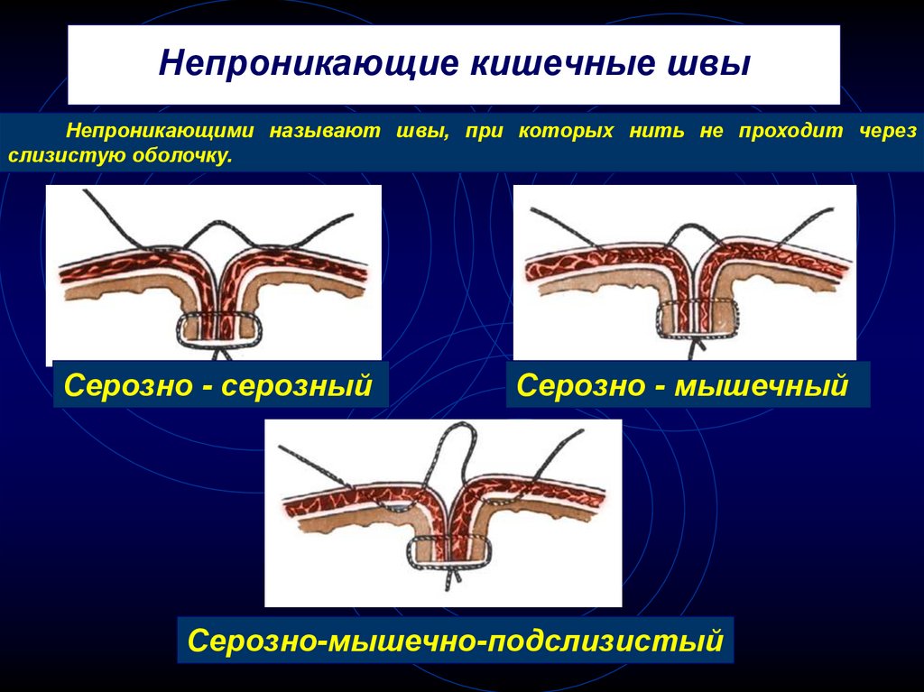 Кишечные швы. Непроникающие кишечные швы. Классификация кишечных швов. Кишечные швы, их классификация.. Требования к кишечному шву.