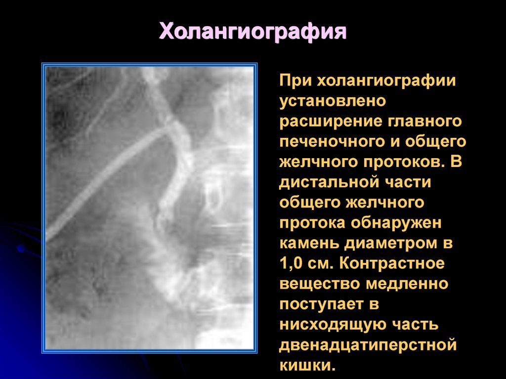 Холангиография. Холангиография рентген описание. Чресфистульная холангиография. Холангиография жёлчных протоков. Контрастная холангиография.