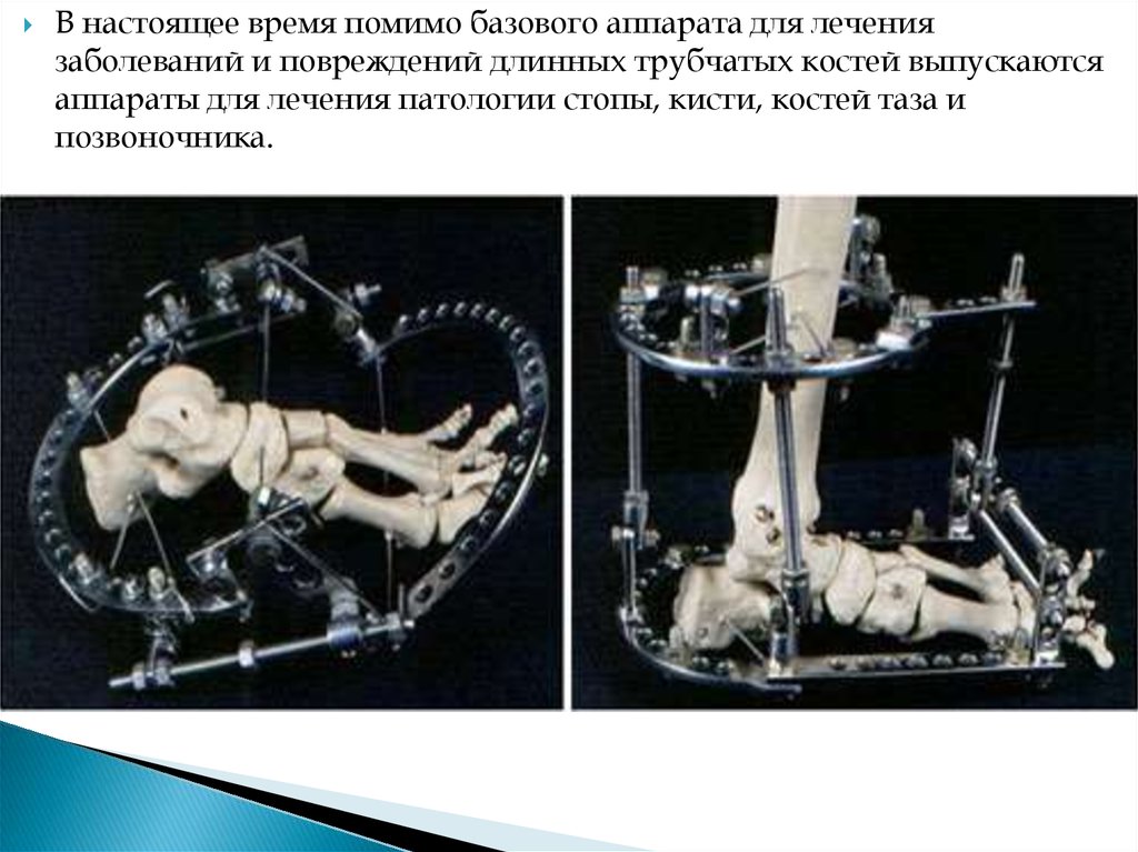 Аппарат илизарова презентация
