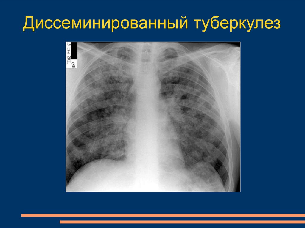 Лимфогенный туберкулез. Лимфогенный диссеминированный туберкулез. Хронический диссеминированный туберкулез легких кт. Диссеминированный туберкулёз лёгких рентген. Диссеминированный туберкулез рентген.