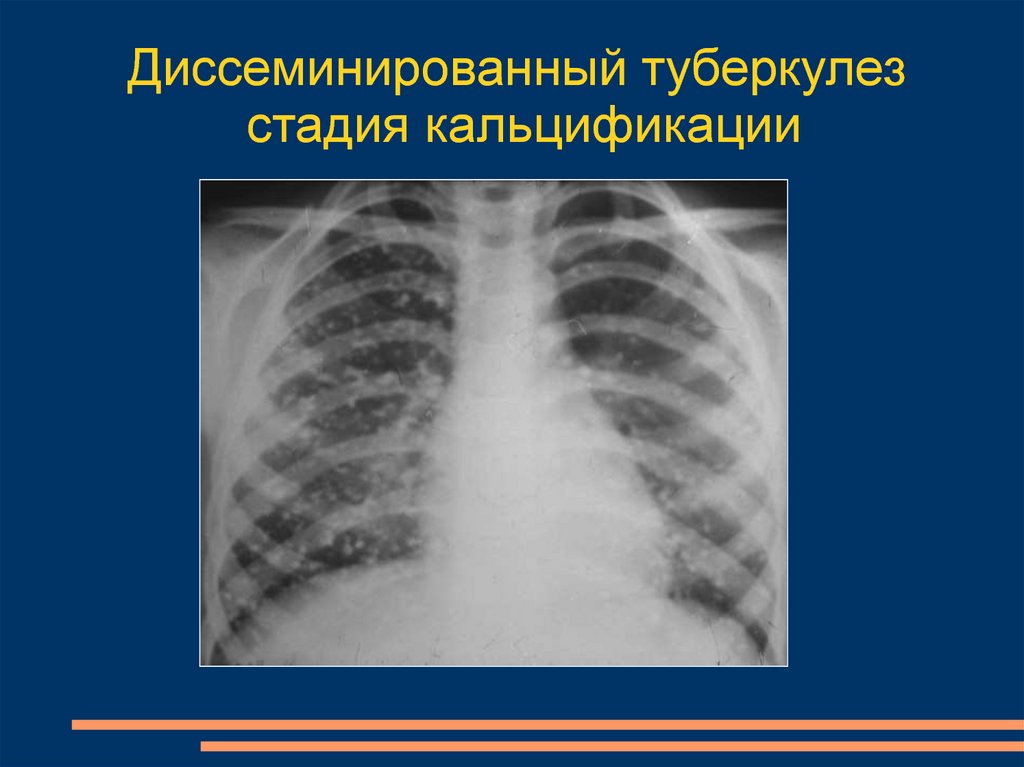 Диссеминированный туберкулез фаза инфильтрации. Диссеминированный туберкулез стадии. Диссеминированного туберкулеза стадия кальцификации.