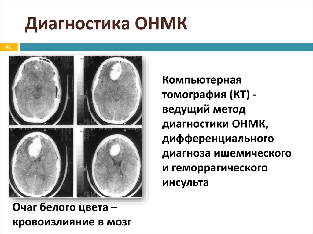 Онкм. Геморрагический инсульт кт. ОНМК по смешанному типу на кт. Диагноз ОНМК. Диагноз острое нарушение мозгового кровообращения.