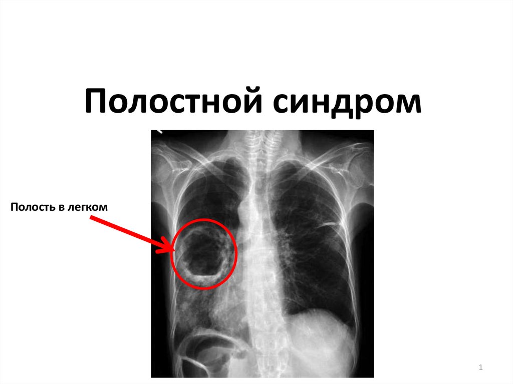 Наличие полости. Синдром полости в легком. Синдори полости в легких. Синдром полости в легочной ткани.