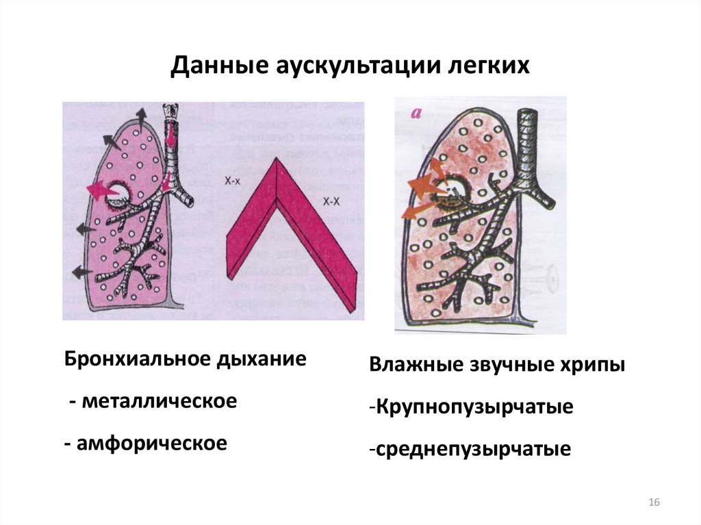 Операции на легких презентация