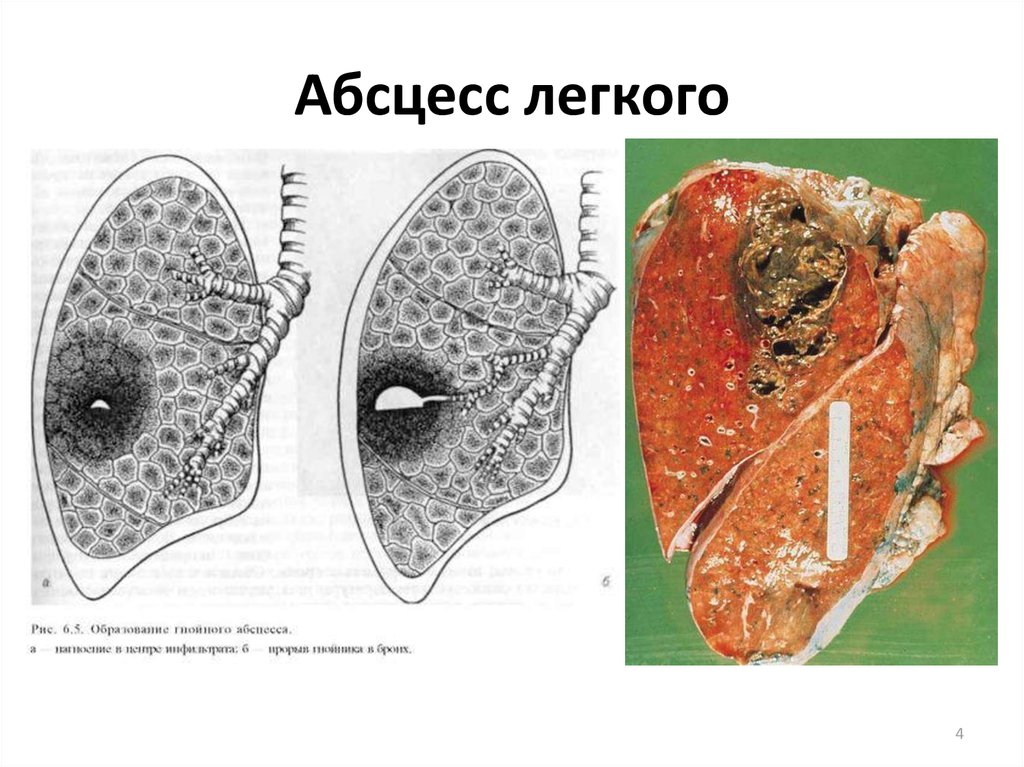 Гангрена легкого