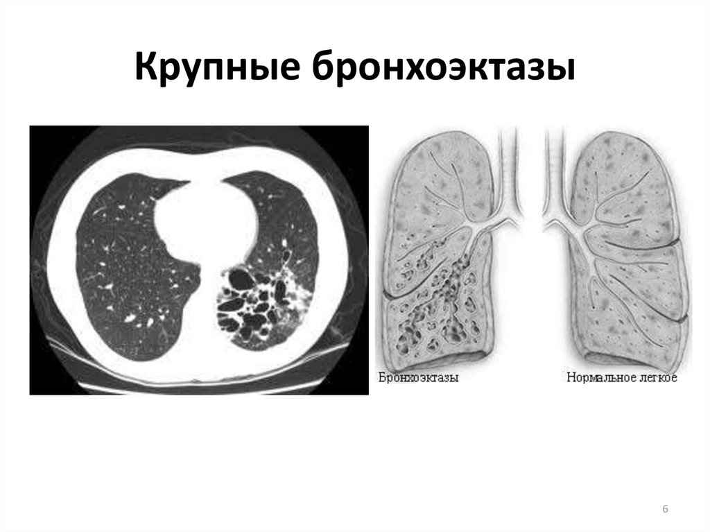 Кт картина бронхоэктазов