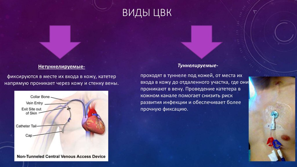 Центральный венозный катетер алгоритм. ЦВК Центральный венозный катетер. Туннелируемый Центральный венозный катетер. Виды ЦВК.