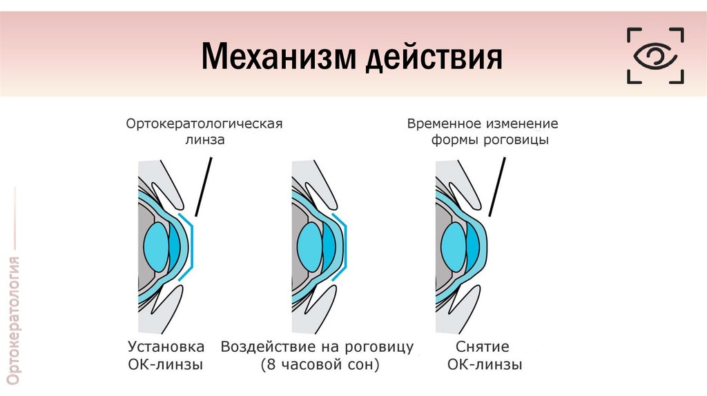 Презентация осложнения при ношении контактных линз