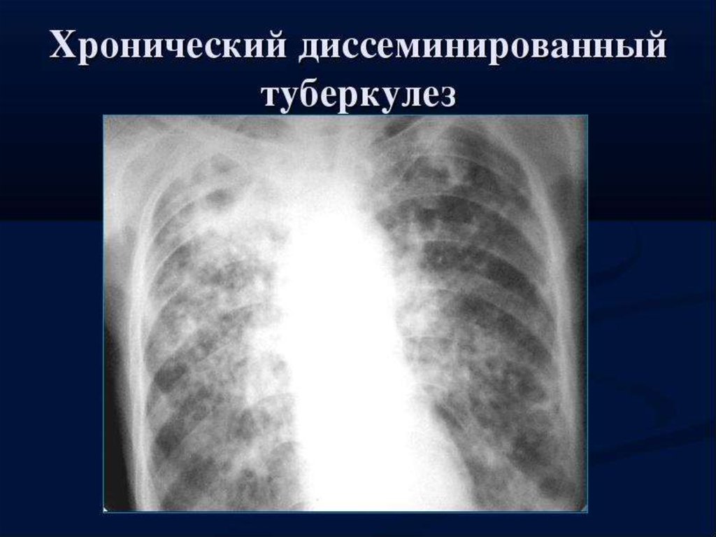 Формы диссеминированного туберкулеза. Острый диссеминированный туберкулез рентген. Хронический очаговый туберкулез на рентгене. Хронический диссеминированный туберкулез. Хронический диссеминированный туберкулез рентген.