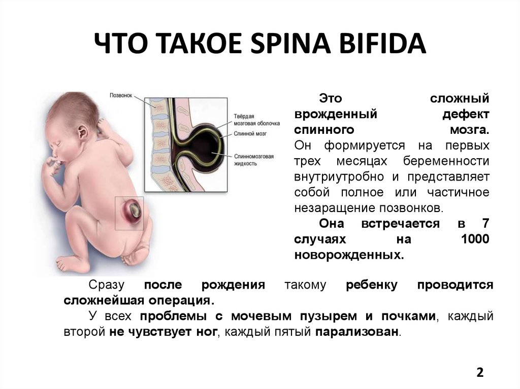 Расщепление позвоночника презентация