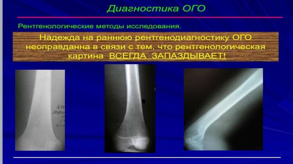 Рентгенодиагностика остеомиелита презентация