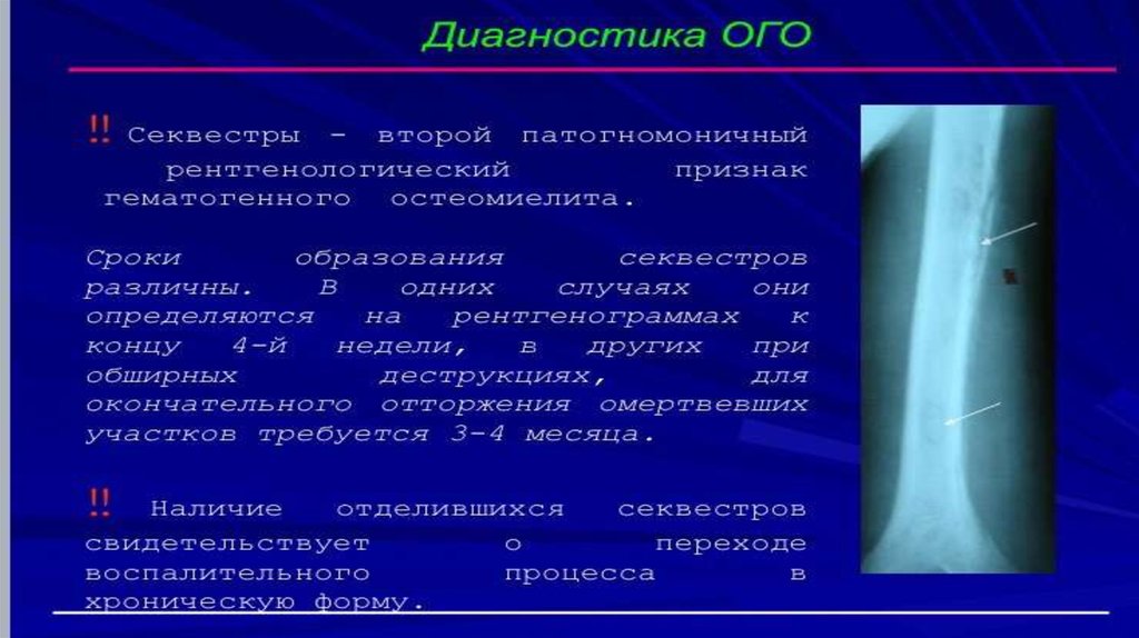 Гематогенный. Гематогенный остеомиелит этиология. Острый гематогенный остеомиелит схема. Патогенез острого гематогенного остеомиелита. Острая фаза гематогенного остеомиелита схема.