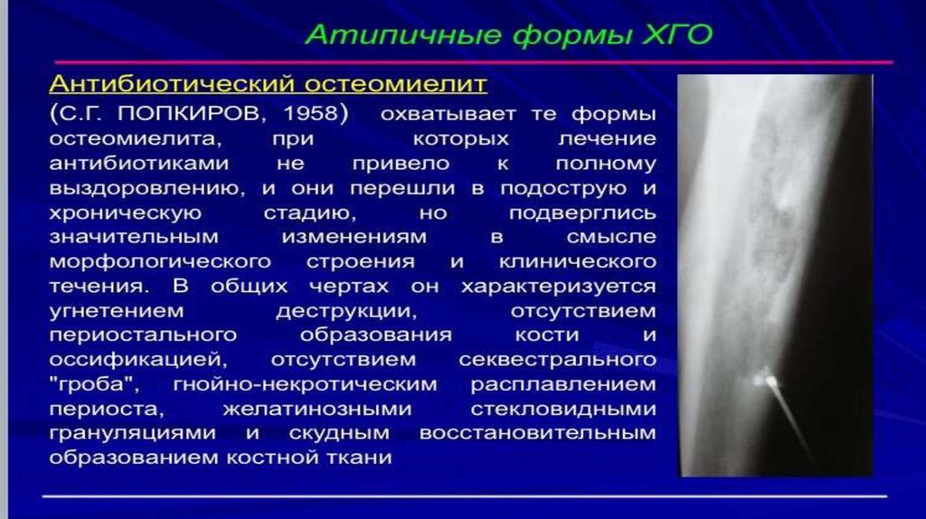 Острый остеомиелит клиническая картина