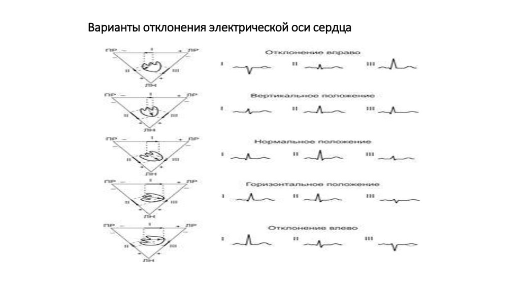 Отклонение электрической оси