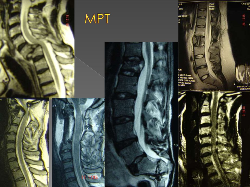 Сделать мрт позвоночника платно. Мрт травмы позвоночника. Мрт при травме позвоночника.