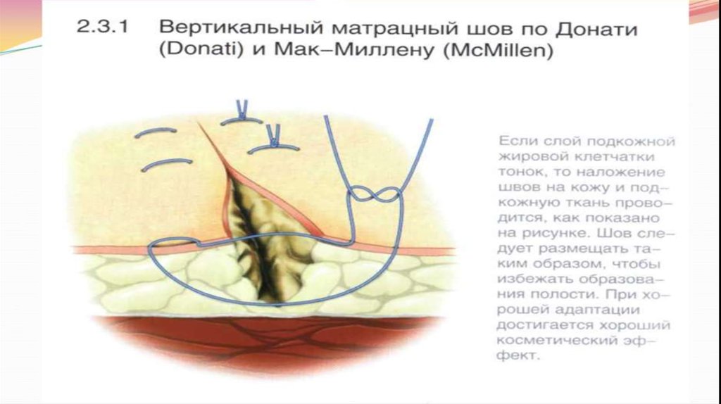 Шов донати схема