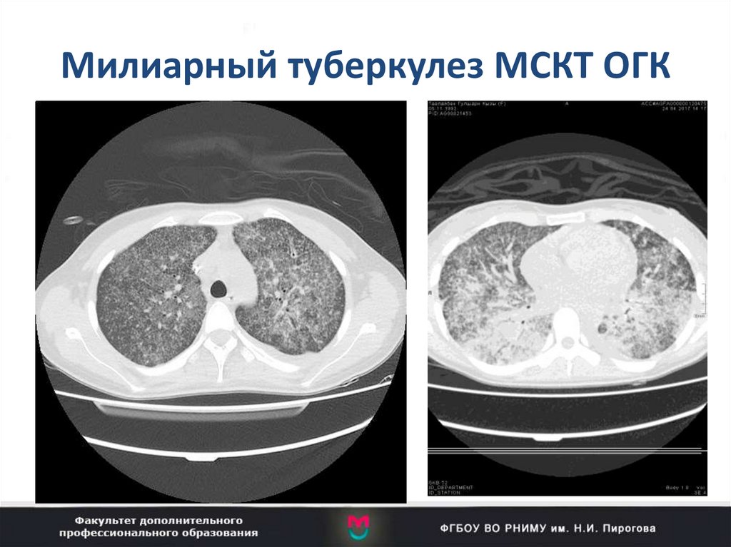 Презентация кт легких