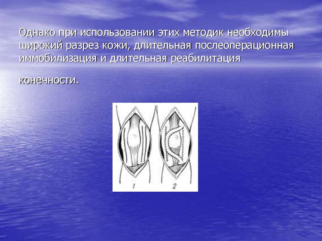 Однако при использовании этих методик необходимы широкий разрез кожи, длительная послеоперационная иммобилизация и длительная