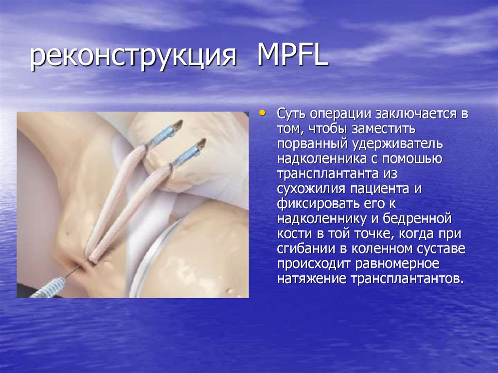 реконструкция MPFL