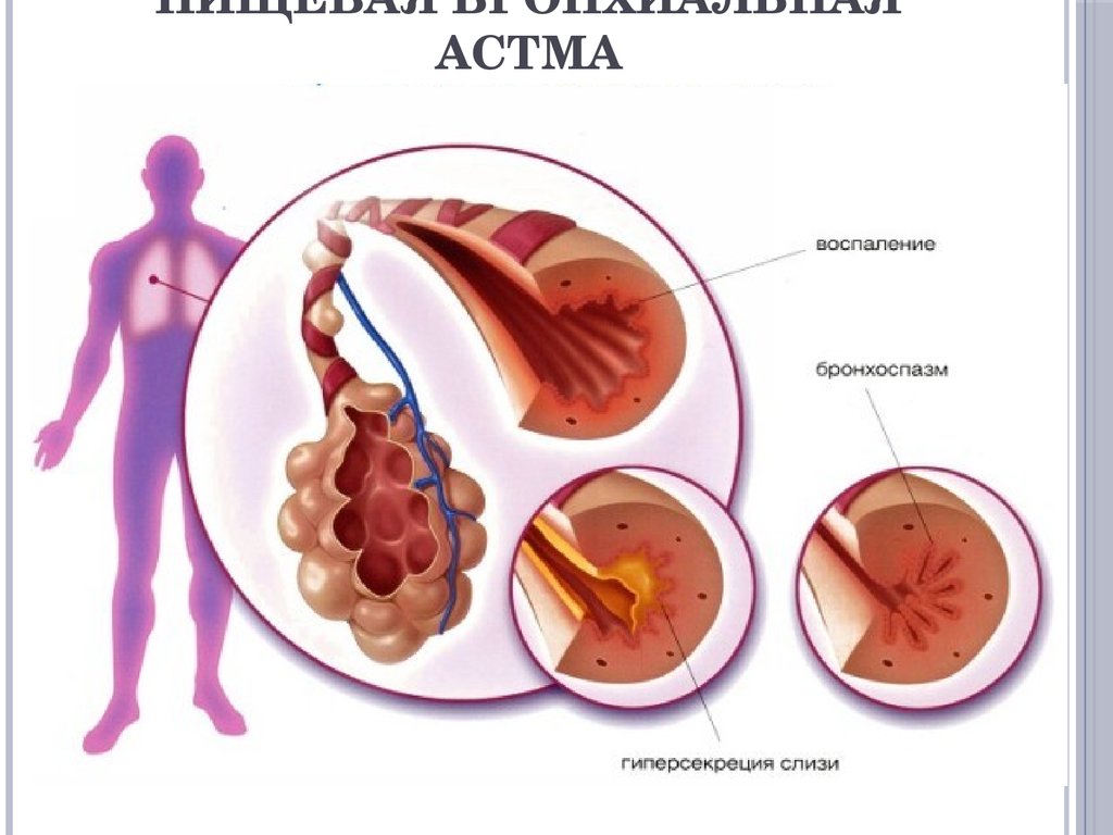 Bronchial asthma. Экзогенная астма. Гиперсекреция слизи бронхиальными железами. Бронхиальная астма бронхоспазм. Бронхиальная астма фото.
