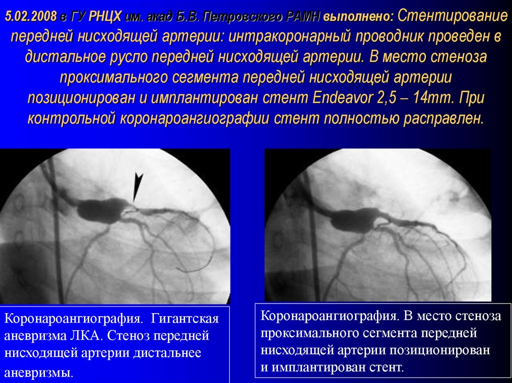 Передняя нисходящая артерия. Стеноз передней нисходящей артерии. Синдрома Кавасаки коронарные артерии. Проксимальный сегмент передней нисходящей артерии. Стентирование передней нисходящей артерии.