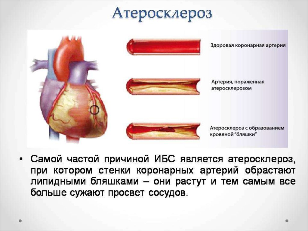 Ишемия симптомы у мужчин. Атеросклероз коронарных артерий симптомы. Симптомы атеросклероза коронарных артерий сердца. Атеросклероз венечных сосудов сердца симптомы. Атеросклероз коронарных сосудов симптомы.