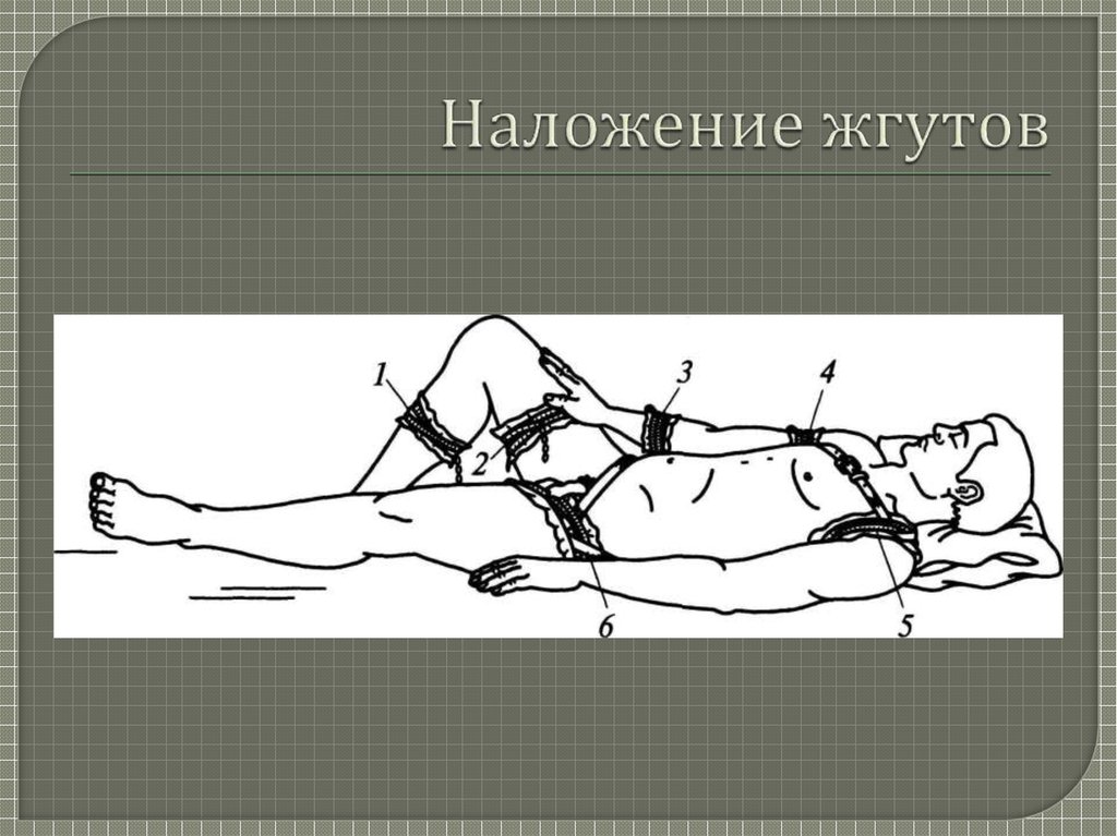 Наложение жгута. Наложение жгутов при легочном кровотечениях. Наложение жгута при кровотечениях рисунок.