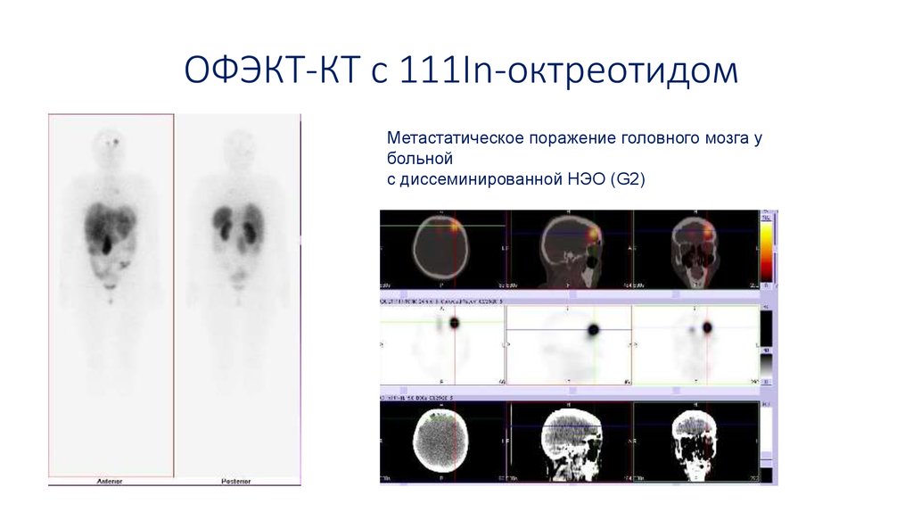 Нейроэндокринные опухоли общие принципы диагностики и лечения руководство