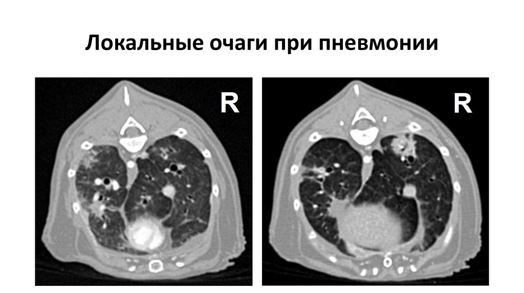 Очаги на кт легких форум. Очаг пневмонии на кт. Локальные очаги.