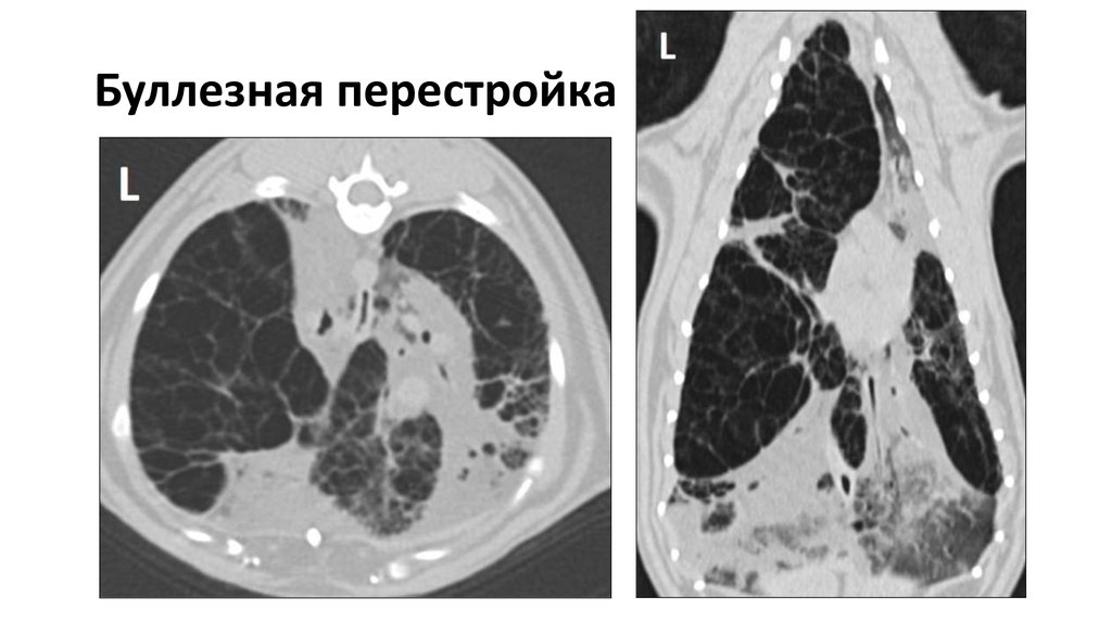 Буллы в легких что это такое. Эмфизема кт. Буллезная форма деструкции легких. Буллёзная болезнь лёгких кт.