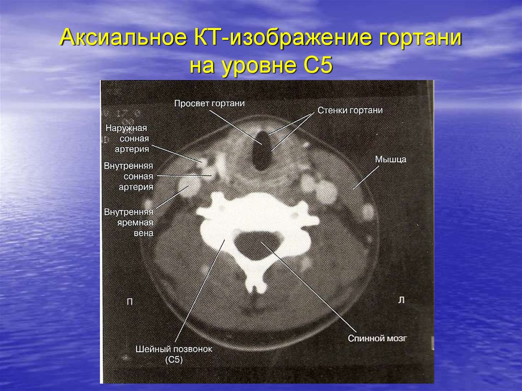 Гортань кт анатомия