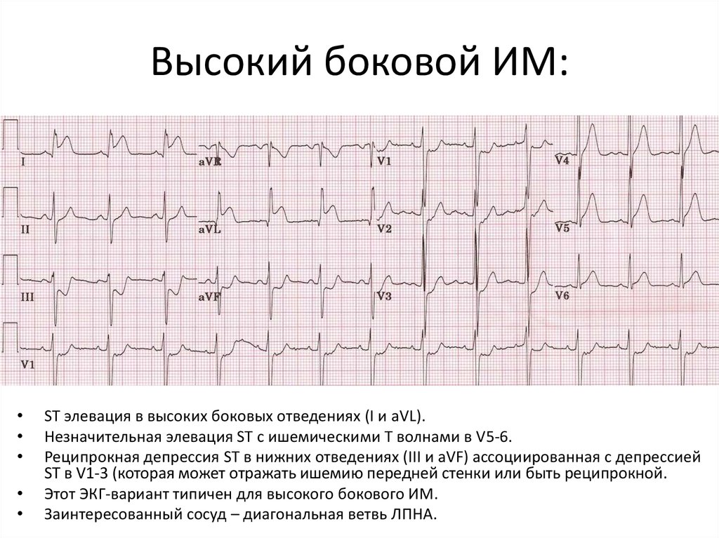 Как выглядит экг при инфаркте миокарда фото с расшифровкой