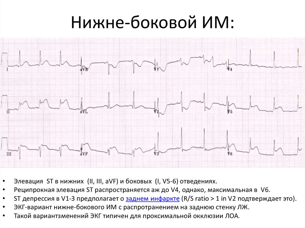 Метаболические изменения на экг