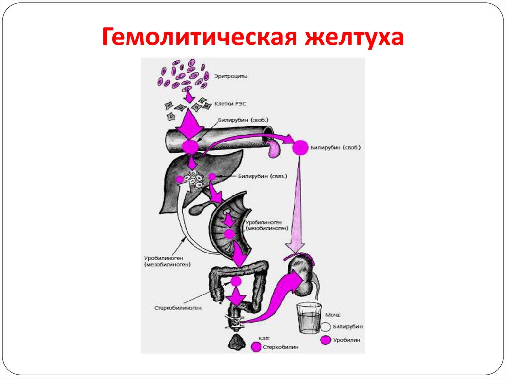 Подпеченочная желтуха схема