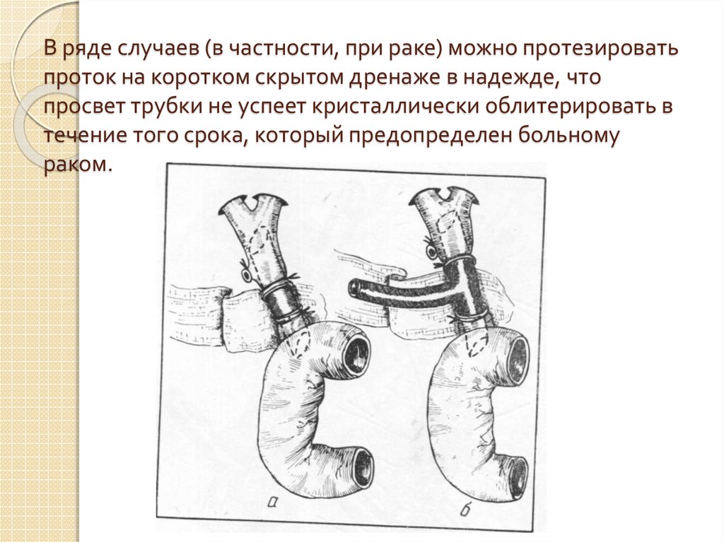 Дренаж после операции на желчных