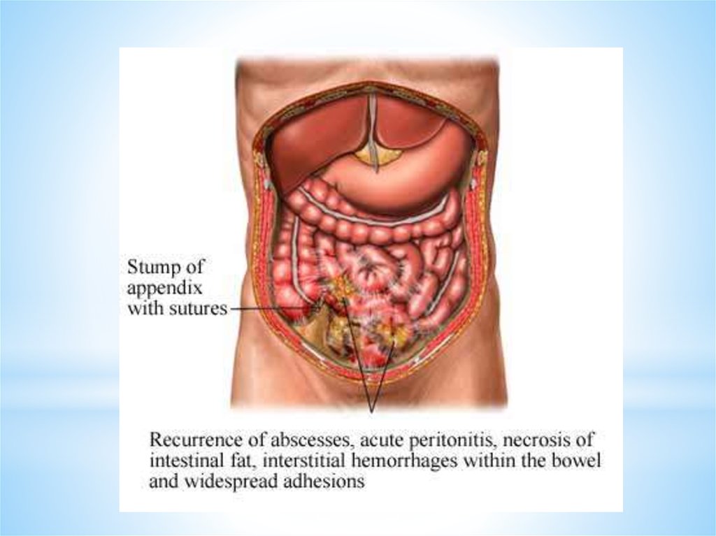 Внутренние органы брюшной полости аппендицит. Наличие гноя в брюшной полости
