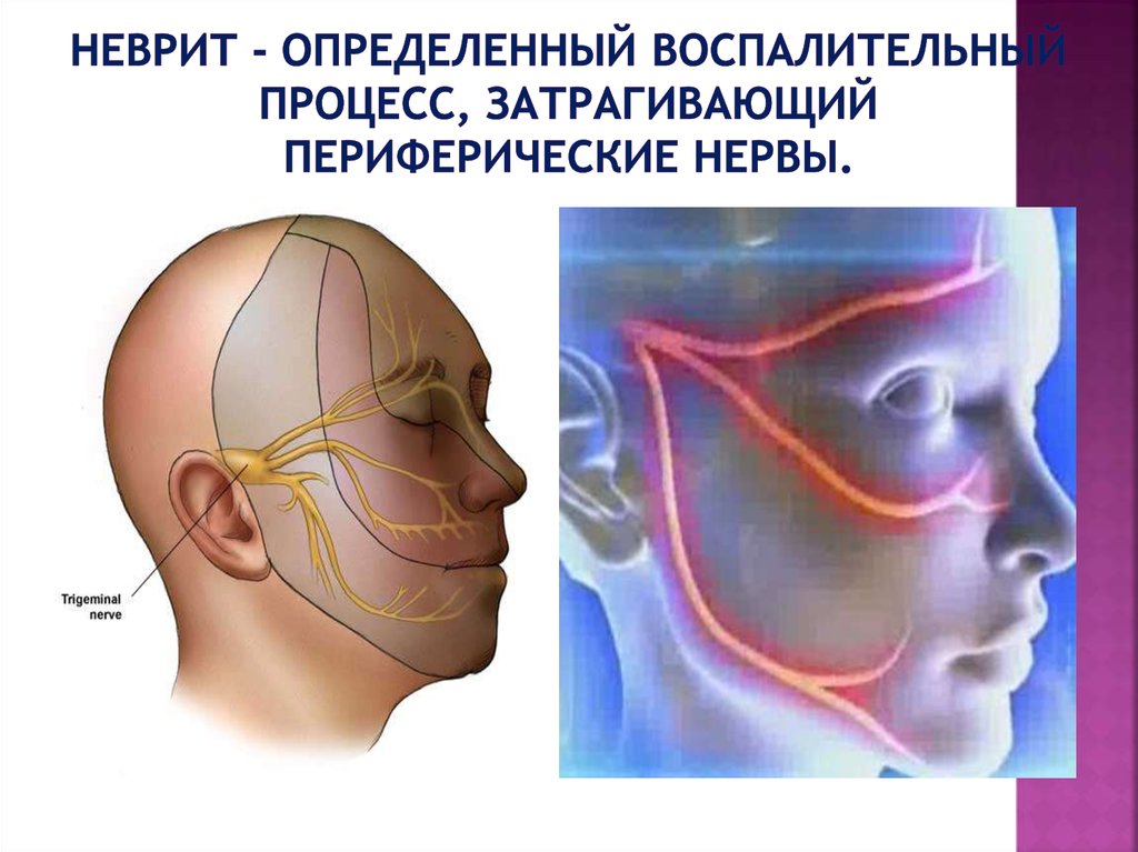 Невропатия (неврит) лицевого нерва.. Неврит тройничного нерва. Нейропатия тройничного нерва клиника. Неврит тройничного лицевого нерва.