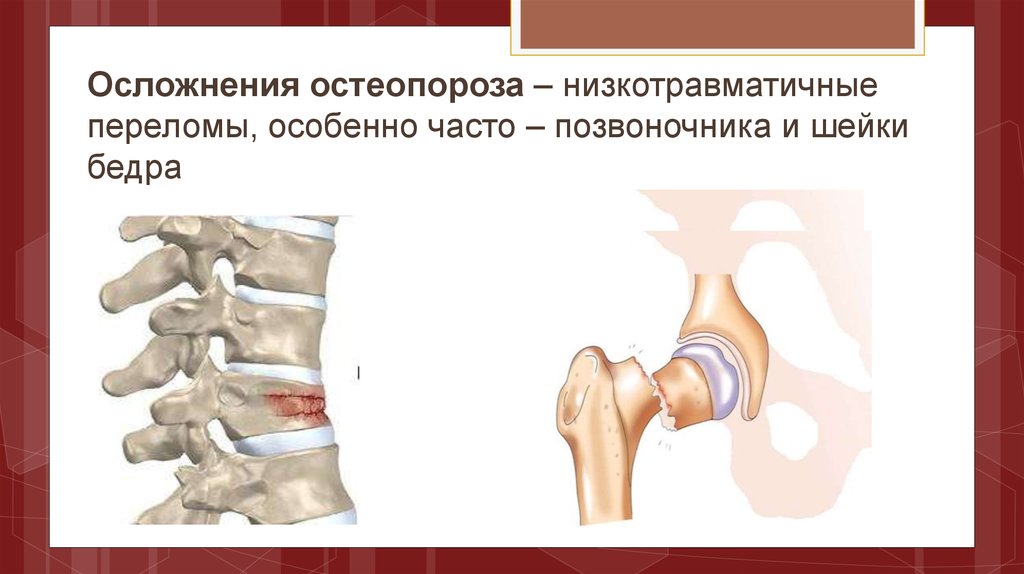 Осложнения при открытых переломах. Остеопороз компрессионный перелом позвоночника. Переломы при остеопорозе. Осложнения остеопороза. Остеопоротические переломы.