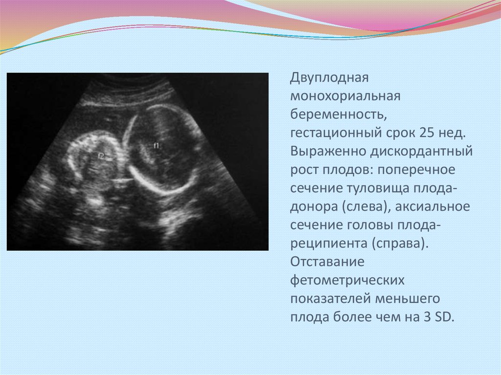 Монохориальная двойня. Монохориальная моноамниотическая беременность. Монохориальная беременность УЗИ. Дискордантное развитие плодов. Монохориальная беременность двойней.