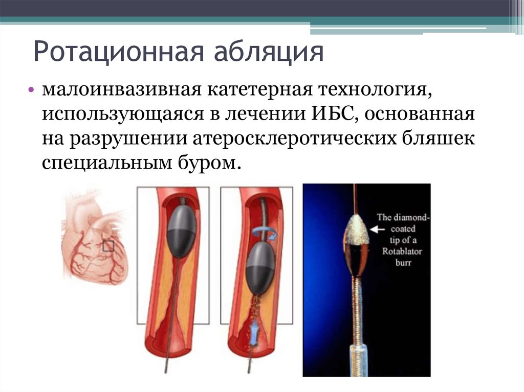 Абляция сердца. Ротационная атерэктомия. Ротационная абляция и атерэктомия. Ротационная ангиопластика.