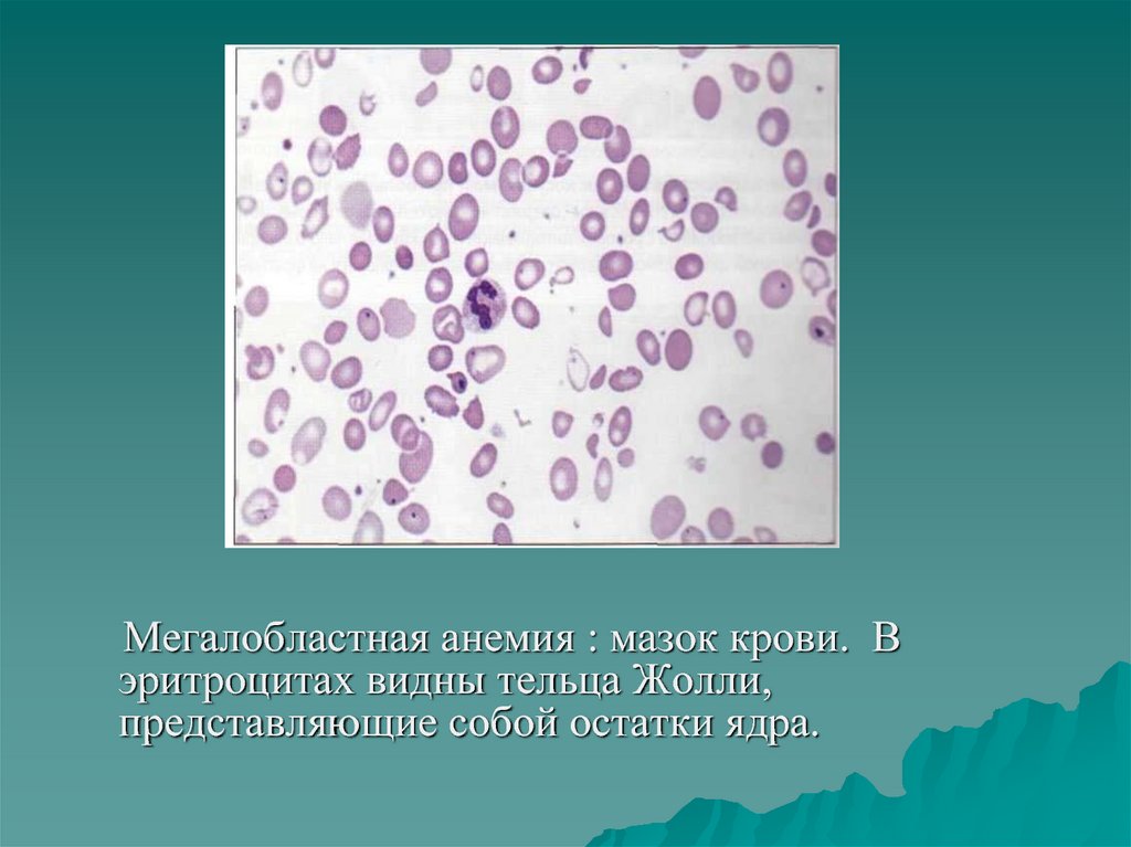 Мегалобластная анемия презентация